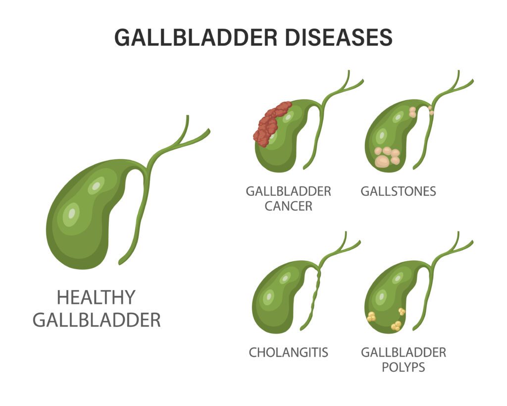 Understanding Gallbladder Disease